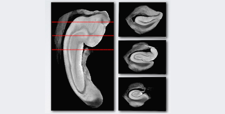A template generated by volumetric registration of 26 ex vivo MRI scans guided by surface correspondences.